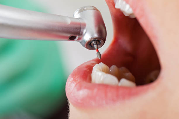Best Emergency Wisdom Teeth Removal in Rocklin, CA